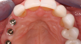 Dental Implant Placement in Concord