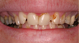 Before Concord Laser Dentistry Procedures