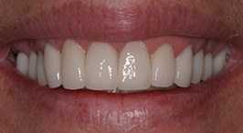 After Concord Laser Dentistry Procedures